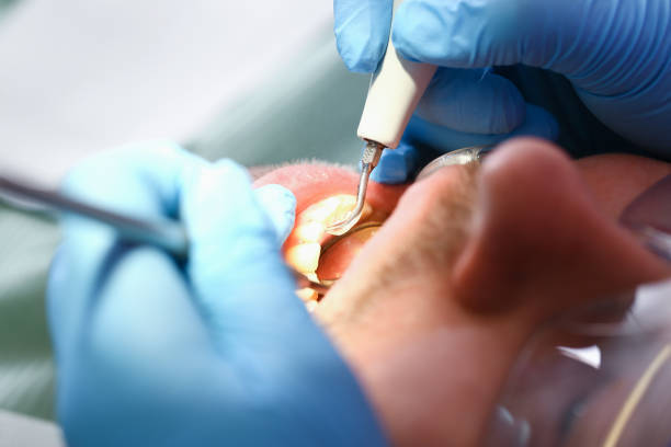 Best Emergency Dental Care for Abscessed Tooth in Dunbar, WV